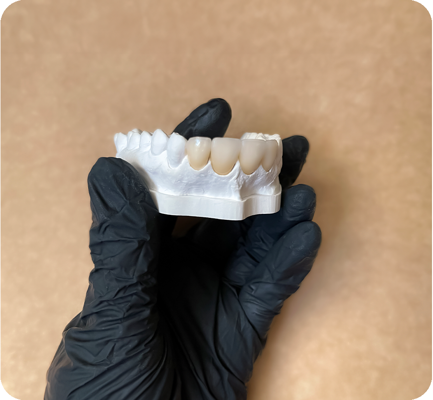 Dental Onlay & Crowns