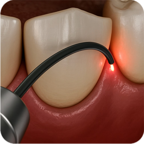Laser Dentistry