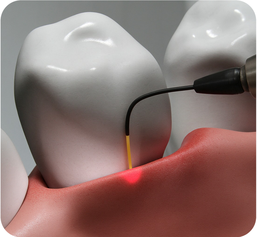 Laser Dentistry