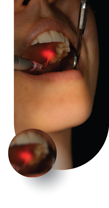 Laser Dentistry