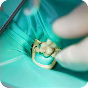 The infected pulp is removed, and the tooth is cleaned and disinfected.